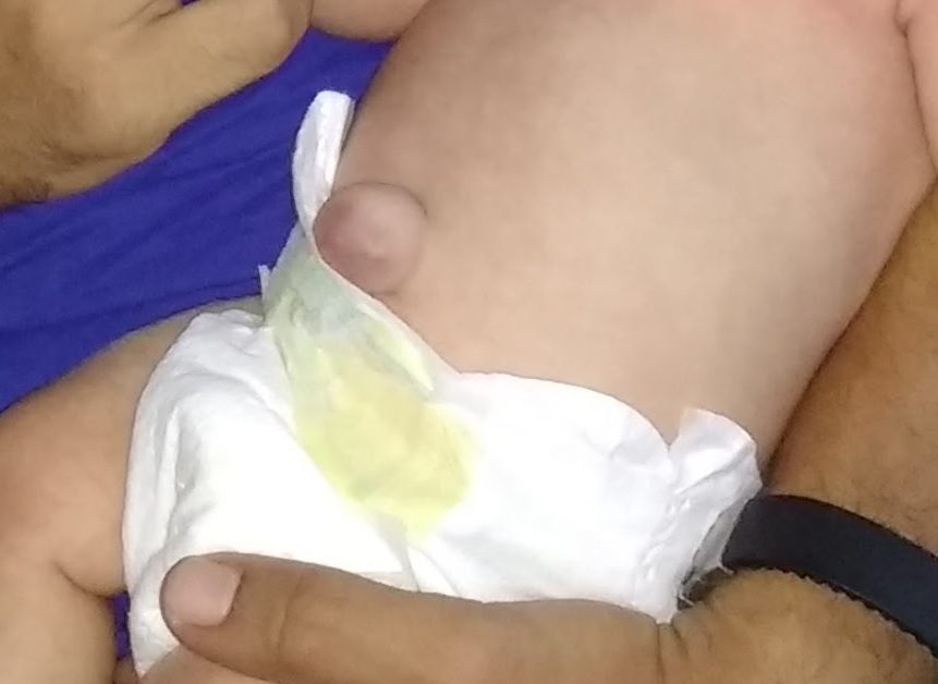 hernia umbilical